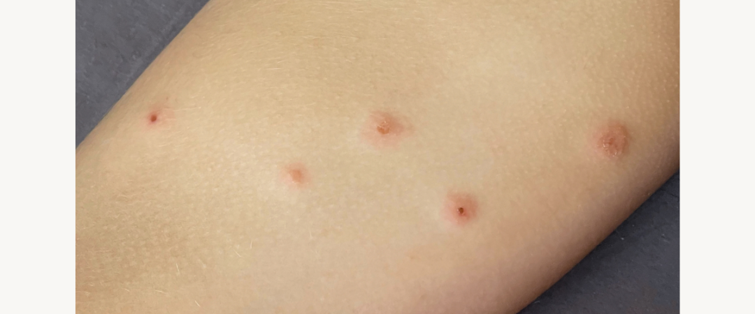 #entreprise punaises de lit Chambéry #entreprise punaises de lit Aix Les Bains #entreprise punaises de lit Savoie #entreprise anti punaises de lit Ain #infestation punaises de lit #désinsectisation puce de lit Yenne
