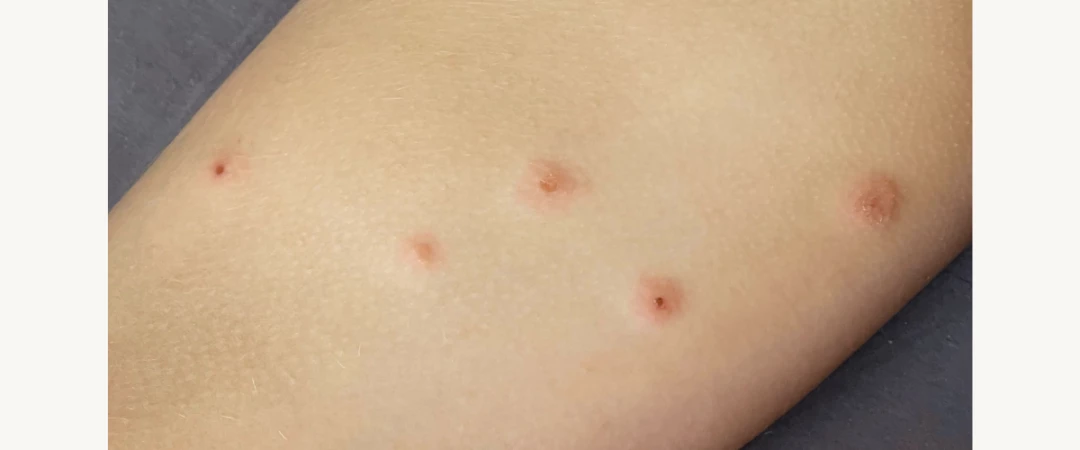 #entreprise punaises de lit Chambéry #entreprise punaises de lit Aix Les Bains #entreprise punaises de lit Savoie #entreprise anti punaises de lit Ain #infestation punaises de lit #désinsectisation puce de lit Yenne